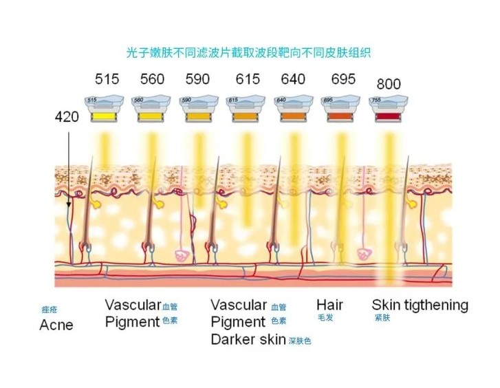 五大光子嫩膚技術(shù)（IPL、DPL、OPT、APT、BBL）及濾光片區(qū)別